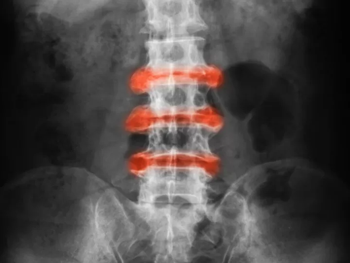 espondiloartrosis