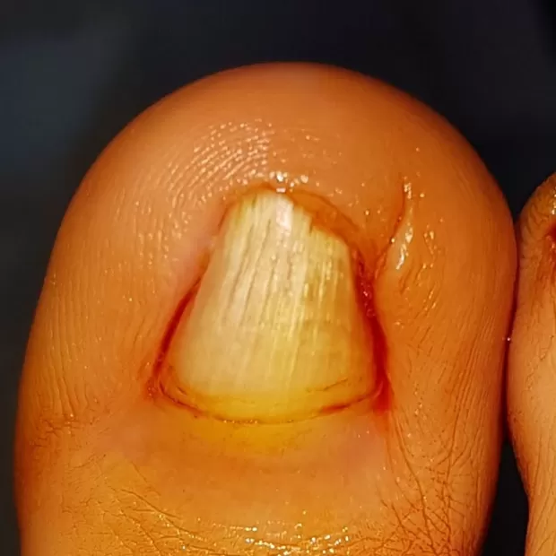 exostosis subungueal